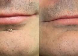✨PuraCure®2-in-1 Microneedle & Hydrocolloid Patch🍀| Removes Raised Moles, Acne, Flat Warts & Skin Tags | Helps Improve Wrinkles, Scars & Blemishes | Invisible Patches for Face & Body