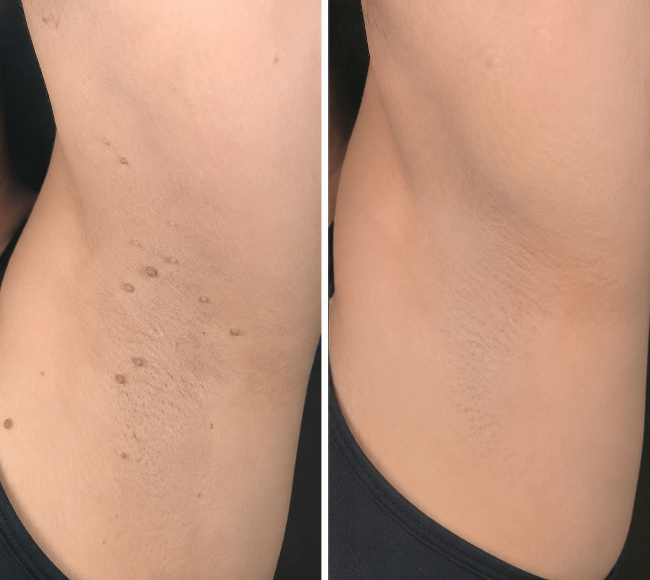 ✨PuraCure®2-in-1 Microneedle & Hydrocolloid Patch🍀| Removes Raised Moles, Acne, Flat Warts & Skin Tags | Helps Improve Wrinkles, Scars & Blemishes | Invisible Patches for Face & Body