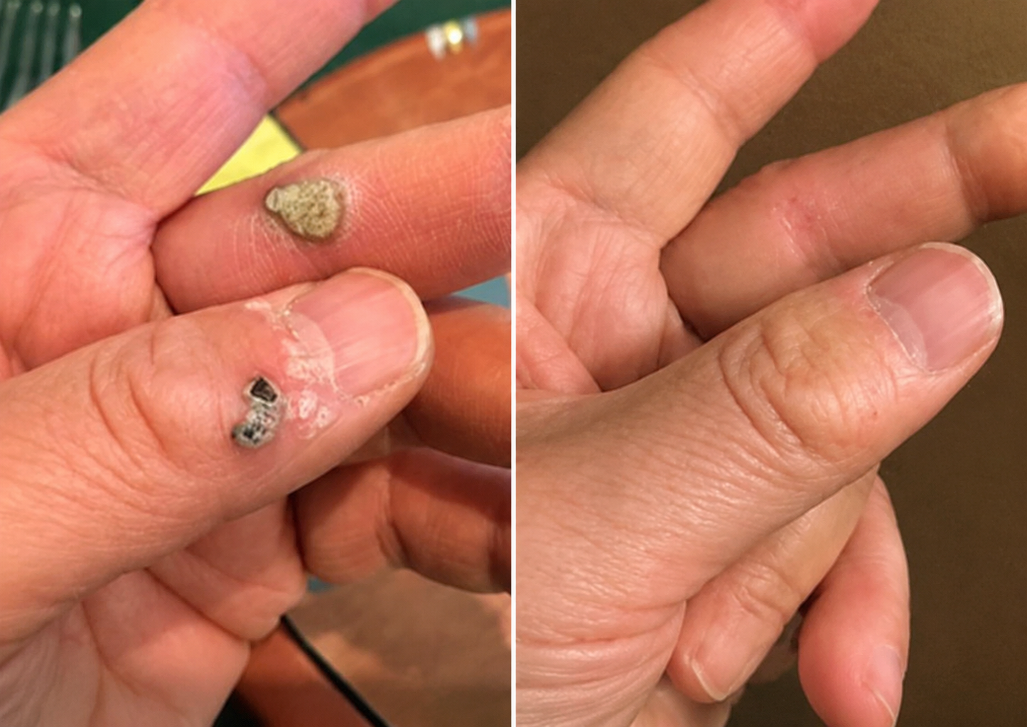 ✨PuraCure®2-in-1 Microneedle & Hydrocolloid Patch🍀| Removes Raised Moles, Acne, Flat Warts & Skin Tags | Helps Improve Wrinkles, Scars & Blemishes | Invisible Patches for Face & Body